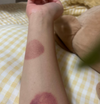 Anti-Cellulite Suction Cup
