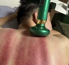 Anti-Cellulite Suction Cup